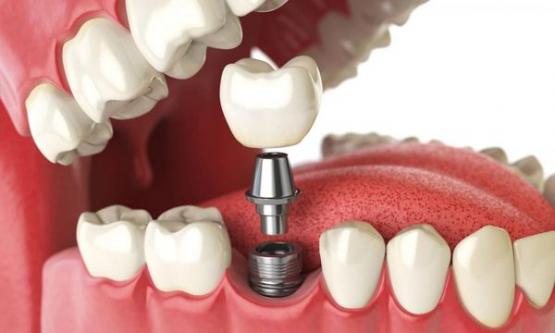 Зубная имплантация как верный способ восстановления зубного  ряда